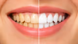 Teeth Whitening: மஞ்சள் கறை படிந்த பற்களை வெள்ளையாக்க சூப்பர் டிப்ஸ்! வீட்டிலேயே பல்பொடி செய்யலாம்?