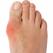 யூரிக் அமில அளவை குறைக்கும் எளிய வழிகள்