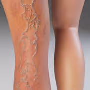 Why Do Varicose Veins Appear? Simple Fixes Before They Become a Problem