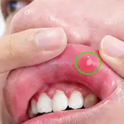 Mouth Ulcer Relief: 8 Effective and Natural Home Remedies
