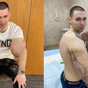 'Russian Popeye' Who Once Injected Vaseline To Increase Biceps Now Could Lose Both Arms