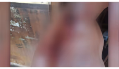 പൊള്ളുന്ന ചൂട്! കൊല്ലത്ത് പത്ത് വയസുകാരന് സൂര്യാതപമേറ്റു, തോളിലും കൈക്കും പൊള്ളലേറ്റു