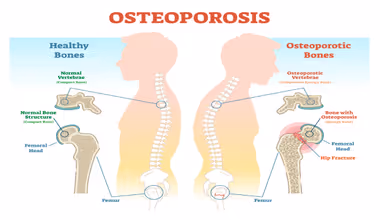 bones damaging: உங்கள் எலும்புகளைப் பலவீனம் ஆக்கும் 5 தினசரி பழக்கங்கள் - மருத்துவர்களின் எச்சரிக்கை!