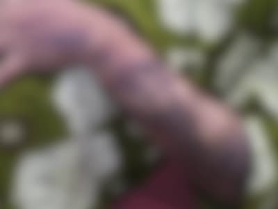 യുവതിയെ പൊള്ളിച്ച് പങ്കാളി