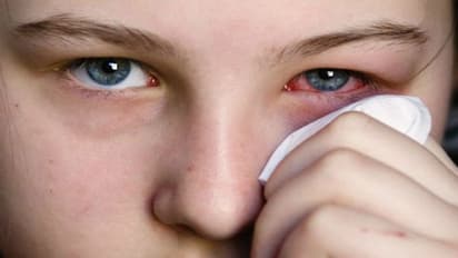 conjunctivitis