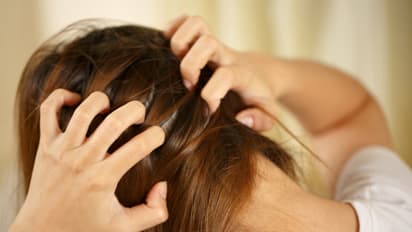 Scalp irritation