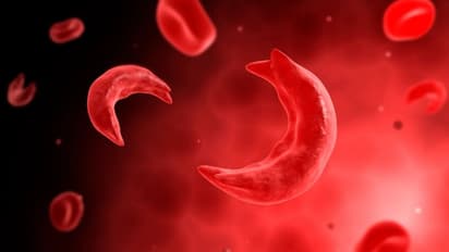 sickle cell disease