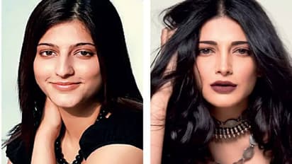 Shruti haasan went surgery
