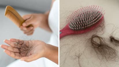 Hair fall reduced by fulfilling the deficiency of 5 vitamins