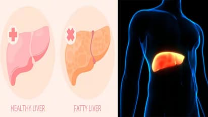 fatty liver 