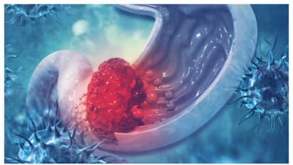 stomach cancer