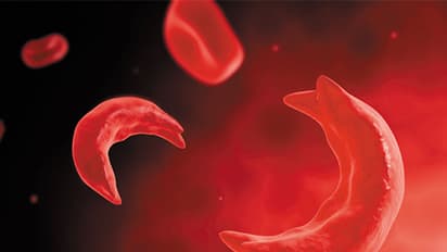 sickle cell anemia
