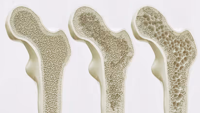 Scientists Reverse Osteoporosis in Mice with AP503