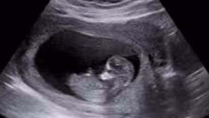 Pregnancy scan
