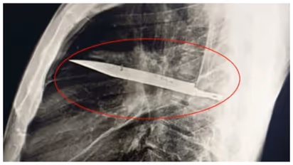 knife found in the young man's chest was lodged 8 years ago