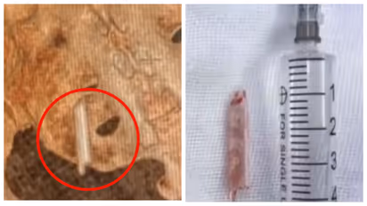 22 year old thermometer was removed from womans pelvis