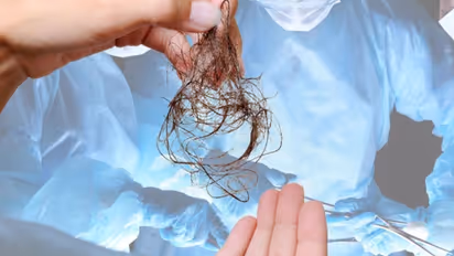 Ahmedabad doctors remove hairball