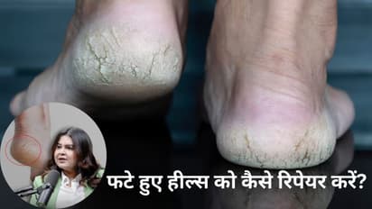 how to heal cracked heels