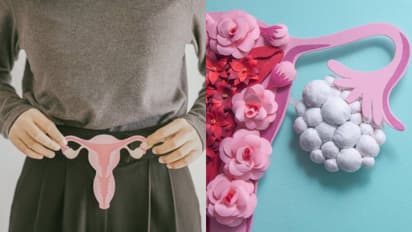 PCOS today vs past difference