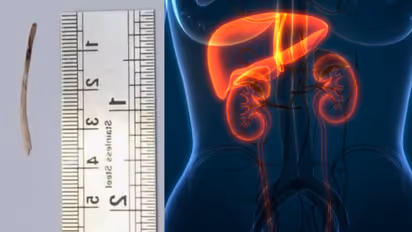 fish bone from liver 