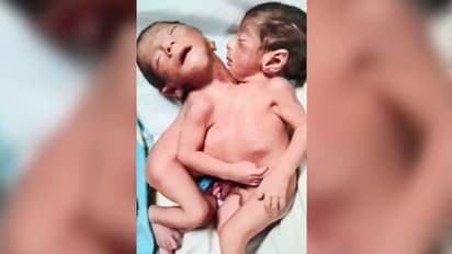 Aligarh conjoined twins woman gave birth to twins with one body later dies