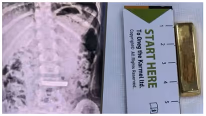 five year old girl swallowed 50 gram gold bar