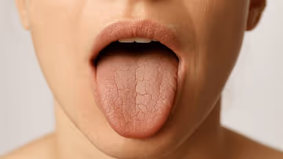 Does your mouth feel dry after waking up Could it be due to some conditions
