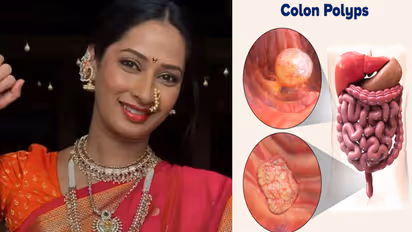 Colon Cancer 6 Warning Signs and Symptoms Cause