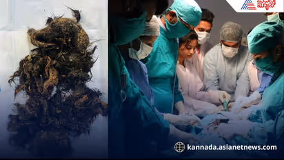 Bengaluru 8yrs girl has trichobezoar doctors perform surgery to remove hair