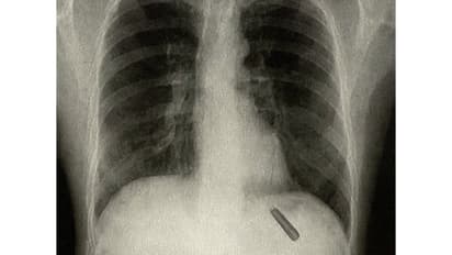 Pen cap stuck in lung