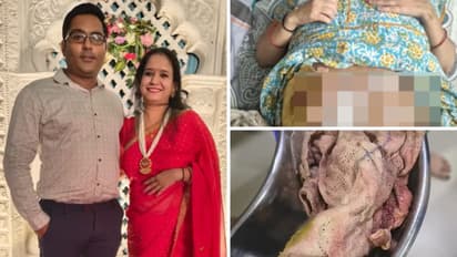 Rajasthan chittorgarh woman c section family alleges surgical mop left inside body hospital denies negligence