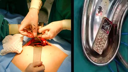 Unique successful operation of doctors surgery18 year old girl swallowed mobile got stuck in the stomach 