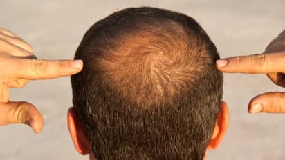 Hair loss myth vs reality