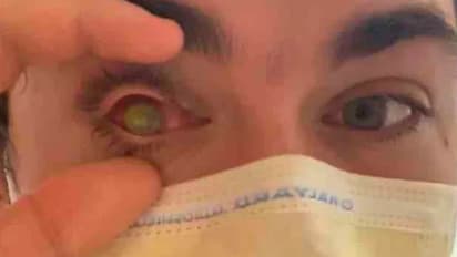 parasite ate eye