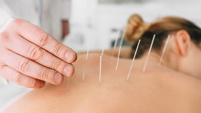 acupuncture