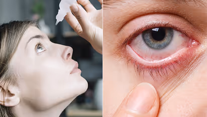 Conjunctivitis Symptoms