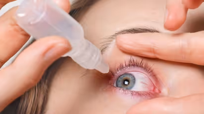 Eye Flu 5 Types and Treatment