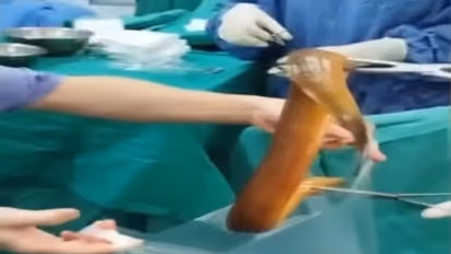 Man Puts Eel in Private part  