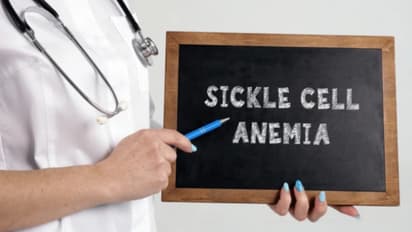 Sickle cell anemia 1