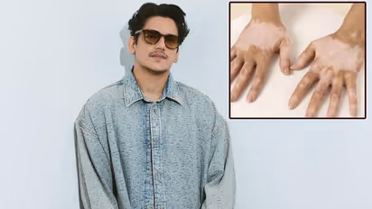  Vitiligo condition know about myth and fact 