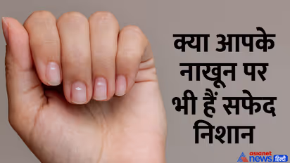 Palmistry-meaning-of-white-marks-on-nails