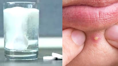 disprin-to-get-rid-of-pimple-and-spots