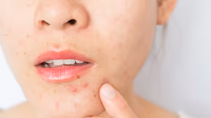 causes of teenage acne