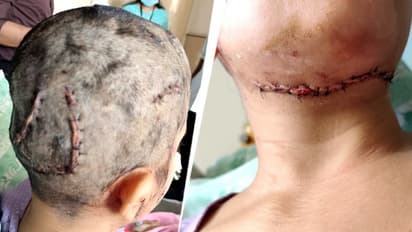 Bengaluru Woman attacked by pet dog