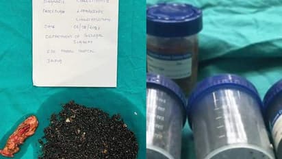 पित्त थैली मेंं मिले स्टोन