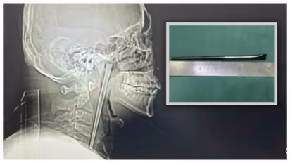 12cm metal chopstick stuck in throat