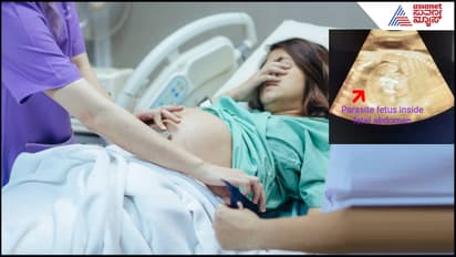 Foetus inside foetus