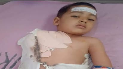 minor boy lost his hand