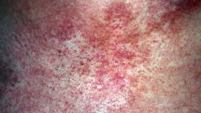 cancer symptoms, cancer diagnosis, scotland, scotland latest news, latest news, viral news, shocking news, trending news