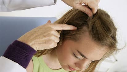 how to get rid from dandruff